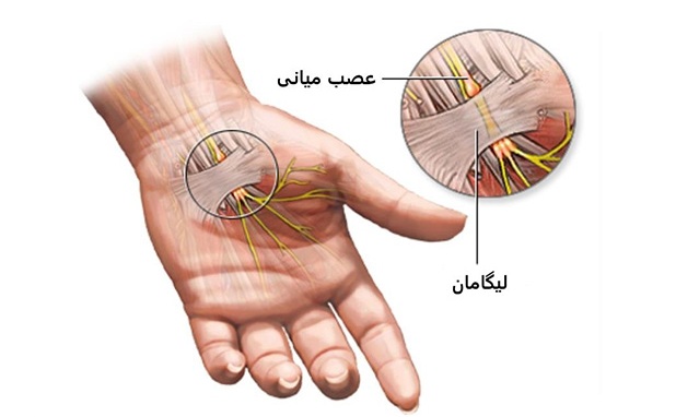 سندرم تونل كارپال